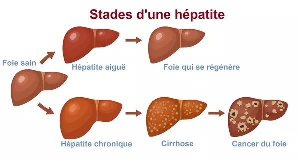stades-d-une-hepatite.jpg