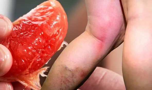 Caillots sanguins: une femme qui mangeait quotidiennement un pamplemousse a failli perdre sa jambe à cause d'une amputation(Image : Getty Images)