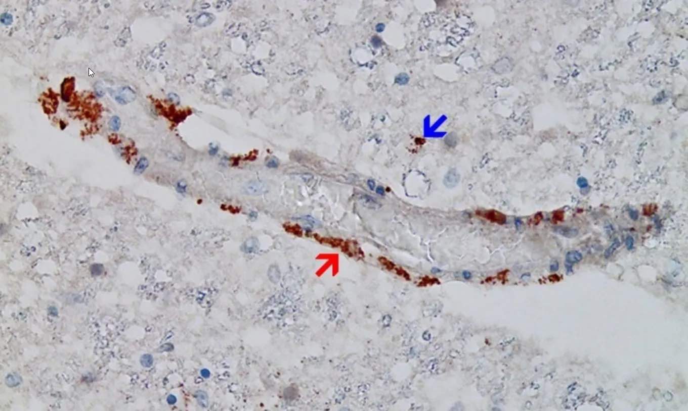 Figure 10. Cerveau, Nucleus ruber. La présence abondante de protéine de pointe SARS-CoV-2 dans l'endothélium gonflé d'un vaisseau capillaire montre des signes aigus d'inflammation avec des infiltrats de cellules inflammatoires mononucléaires clairsemés (même vaisseau que celui illustré à la figure 12, coupes en série de 5 à 20 μm). Démonstration immunohistochimique de la sous-unité 1 de la protéine de pointe du SRAS-CoV-2 visible sous forme de granules bruns dans les cellules endothéliales capillaires (flèche rouge) et les cellules gliales individuelles (flèche bleue). Grossissement : 200× Source: MDPI-Vaccin — https://www.mdpi.com/2076-393X/10/10/1651
