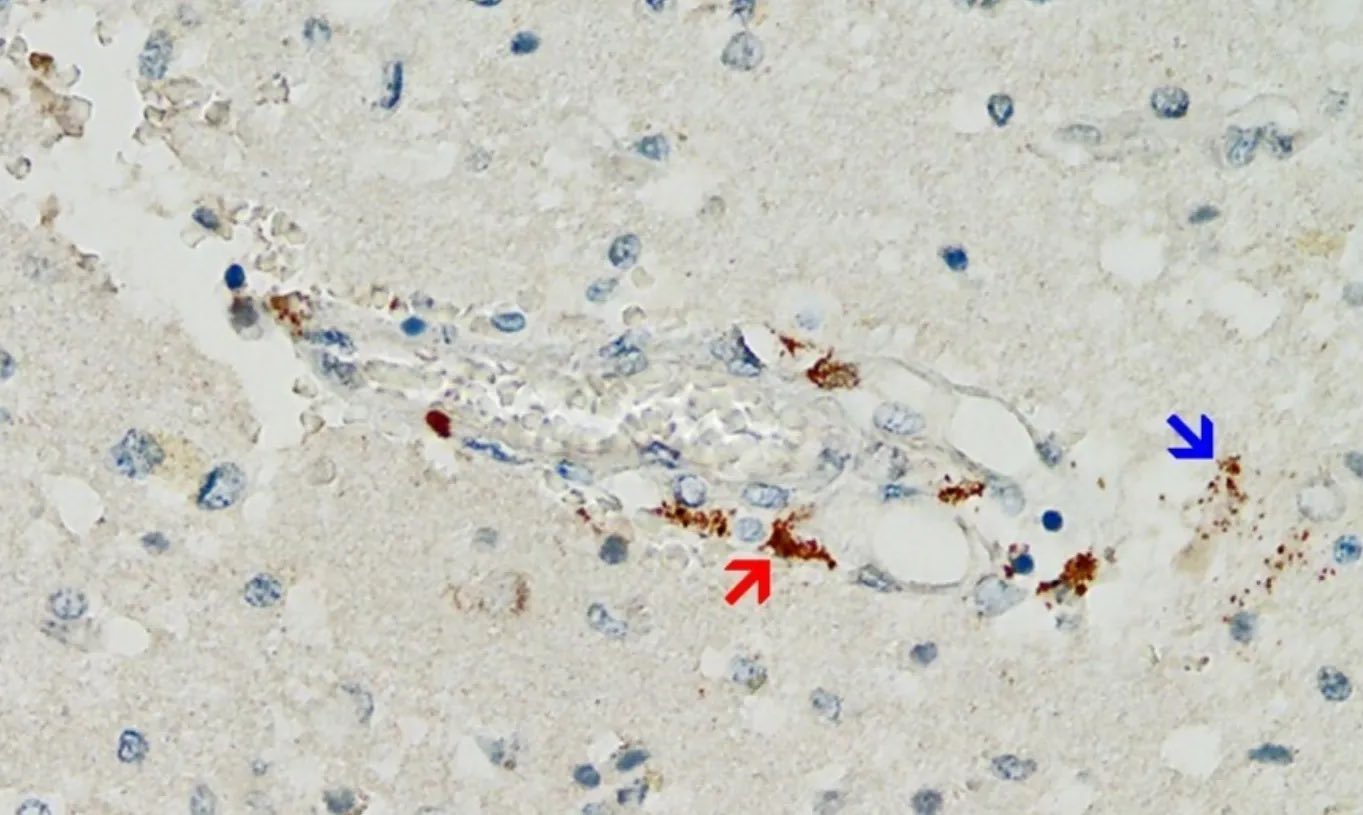 Figure 9. Cerveau frontal. Réaction positive pour la protéine de pointe SARS-CoV-2. Coupe transversale à travers un vaisseau capillaire (même vaisseau que celui illustré à la figure 11, coupes en série de 5 à 20 μm). Réaction immunohistochimique pour la sous-unité 1 de la pointe du SRAS-CoV-2 détectable sous forme de granules bruns dans les cellules endothéliales capillaires (flèche rouge) et les cellules gliales individuelles (flèche bleue). Grossissement : 200×. Source: MDPI-Vaccins — https://www.mdpi.com/2076-393X/10/10/1651