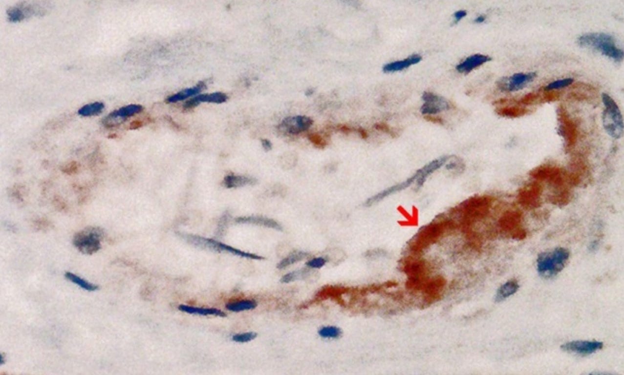 Figure 13. Ventricule cardiaque gauche. Réaction positive pour la protéine de pointe SARS-CoV-2. Coupe transversale à travers un vaisseau capillaire (même vaisseau que celui illustré à la figure 14, coupes en série de 5 à 20 μm). Démonstration immunohistochimique de la sous-unité 1 de la pointe du SRAS-CoV-2 sous forme de granules bruns. Notez la présence abondante de protéines de pointe dans les cellules endothéliales capillaires (flèche rouge) associée à un gonflement endothélial important et à la présence de quelques cellules inflammatoires mononucléaires. Grossissement : 400×. Source: MDPI-Vaccines — https://www.mdpi.com/2076-393X/10/10/1651