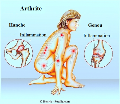 artrite-dans-le-corps.png